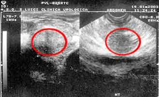 ecografia prostata adenoma