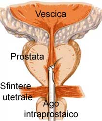 benignus prostata hyperplasia gyógyszer ahol egy személynek prostatitis van