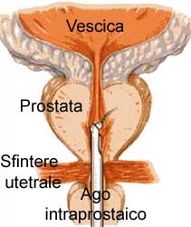 adenoma bilobato prostatico térd gonarthrosis kezelési áttekintés