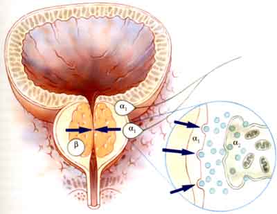 prostata adenoma bilobato